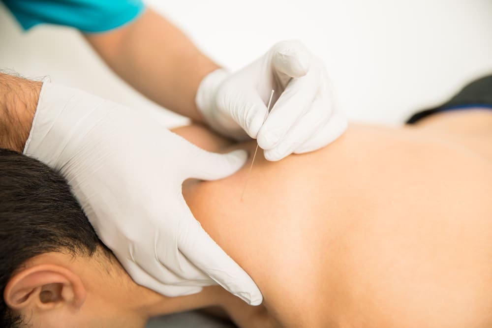 Man Receiving Dry Needling Therapy from Doctor