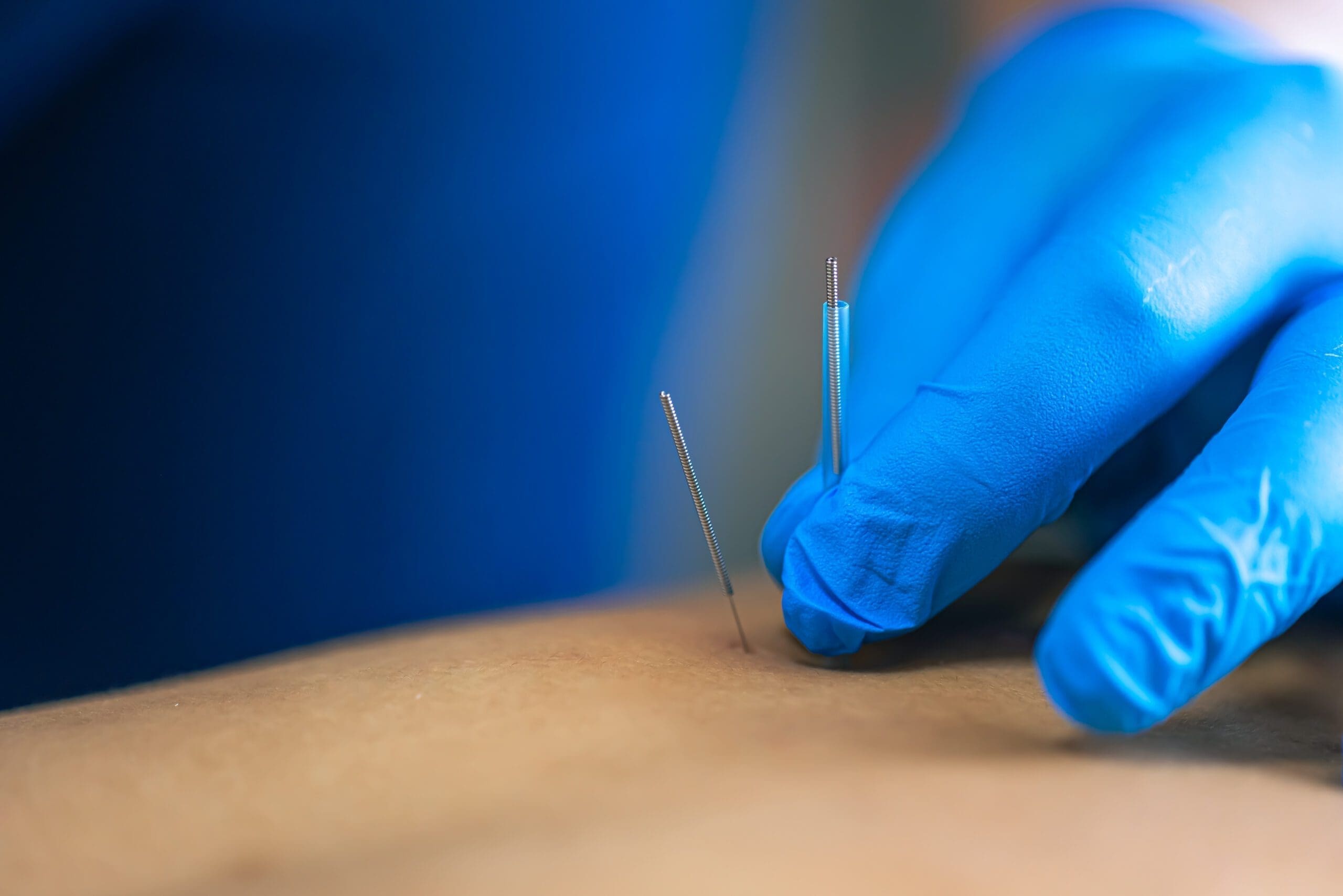Physiotherapist performing dry needling treatment