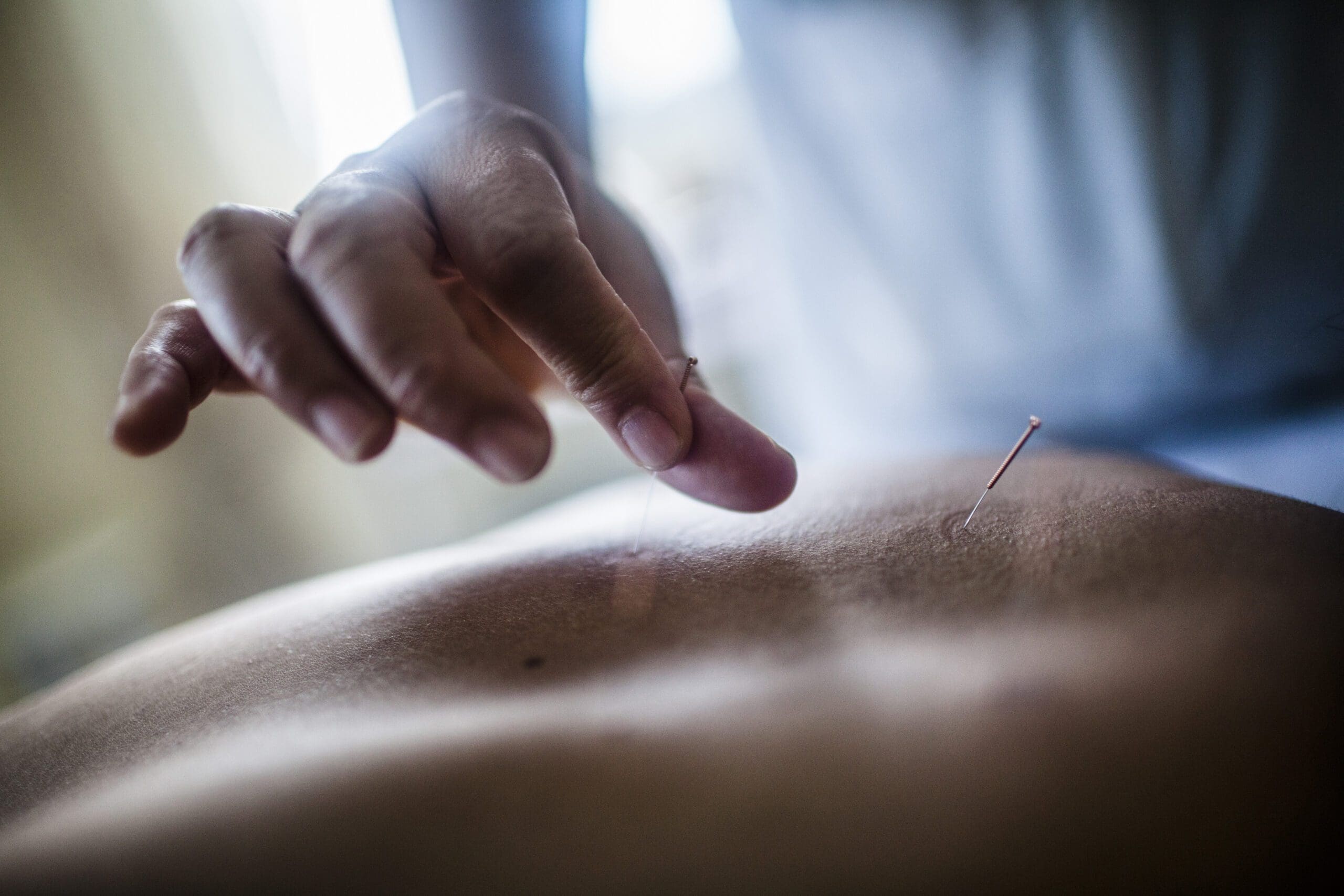 Performing acupuncture on a patient's back
