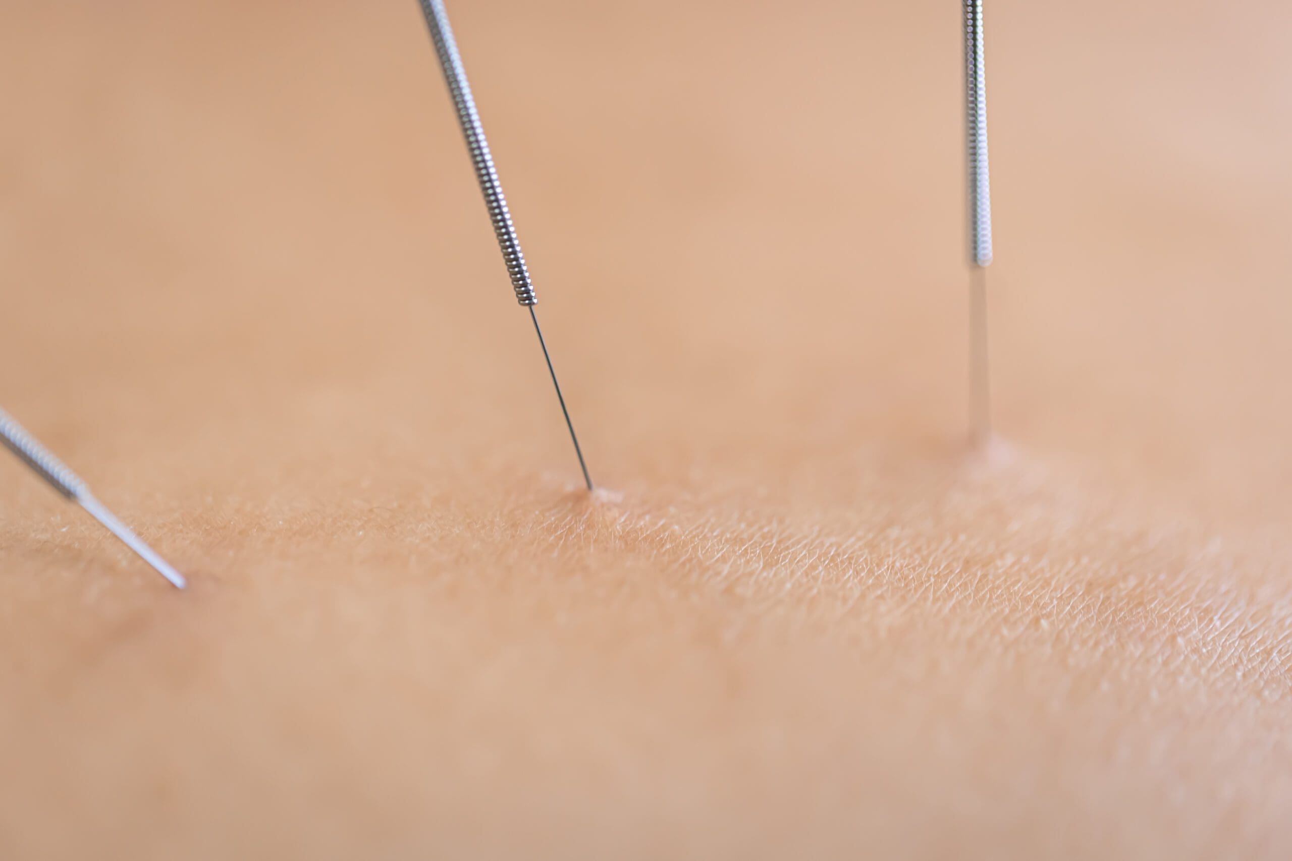 Dry needling acupuncture needles